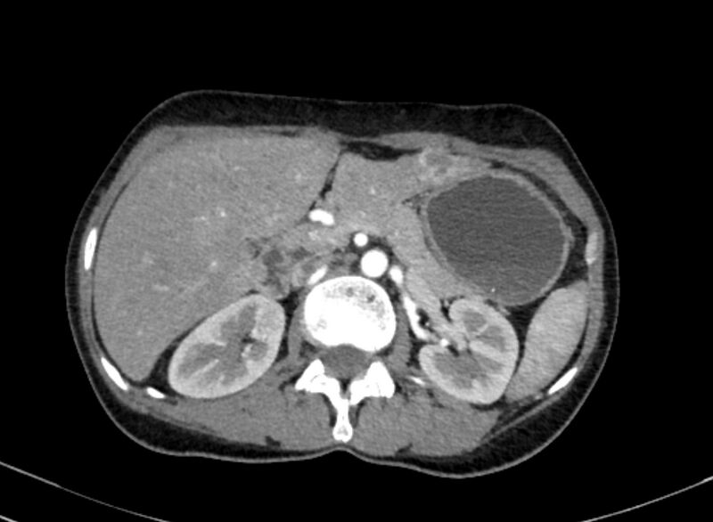 File:Cannonball metastases from breast cancer (Radiopaedia 91024-108569 A 131).jpg