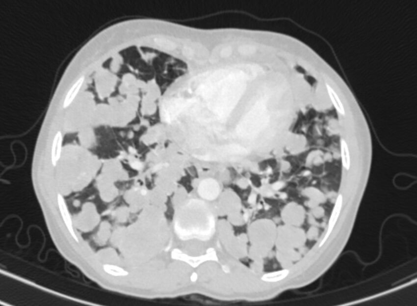 Cannonball metastases from breast cancer (Radiopaedia 91024-108569 Axial lung window 69).jpg