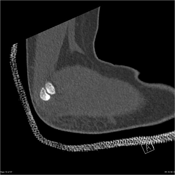 File:Capitellum fracture (Radiopaedia 23352-23426 Sagittal bone window 51).jpg