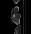 Caput medusae (Radiopaedia 60632-68360 B 8).jpg