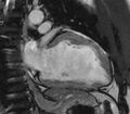 Cardiac sarcoidosis (Radiopaedia 39811-42243 B 27).jpg