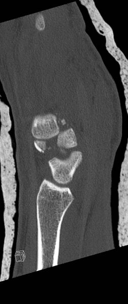 File:Carpal fractures (smart watch impaction) (Radiopaedia 55844-62430 Sagittal bone window 28).jpg