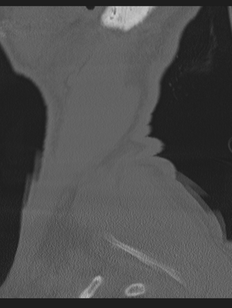 File:Cavernoma of cervical cord (Radiopaedia 50838-56346 Sagittal bone window 79).png