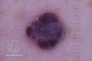 Cavernous haemangioma, nonpolarised dermoscopy view