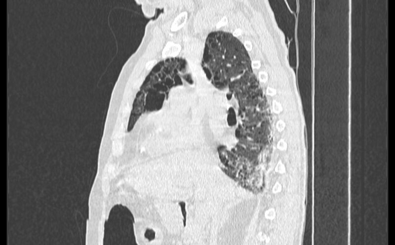 File:Cavitating bronchogenic carcinoma (Radiopaedia 44489-48162 Sagittal lung window 22).jpg