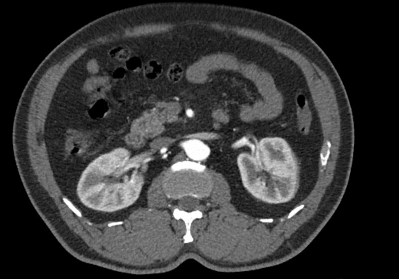 File:Celiac artery dissection (Radiopaedia 52194-58080 A 41).jpg