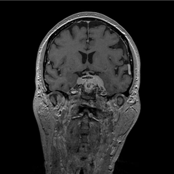 File:Central base of skull meningioma (Radiopaedia 53531-59549 Coronal T1 C+ 14).jpg