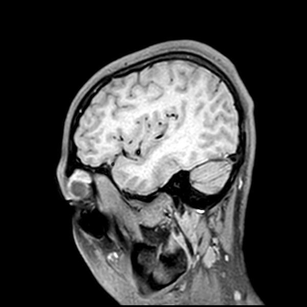 File:Central neurocytoma (Radiopaedia 79320-92380 Sagittal T1 62).jpg