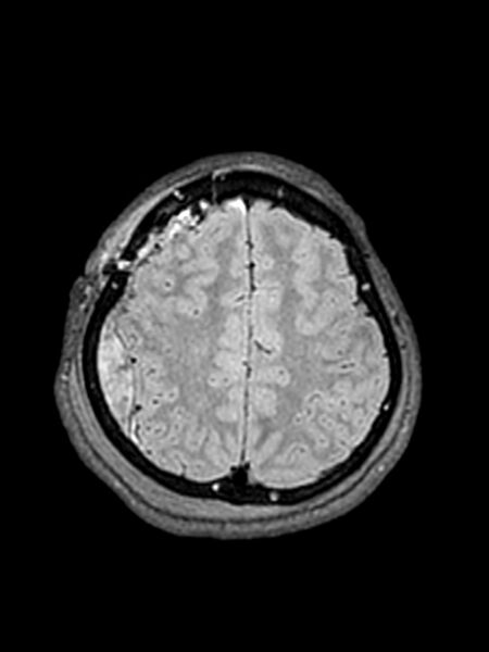File:Central neurocytoma (Radiopaedia 79320-92381 Axial FLAIR 48).jpg