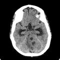 Cerebellar abscess secondary to mastoiditis (Radiopaedia 26284-26412 Axial non-contrast 56).jpg