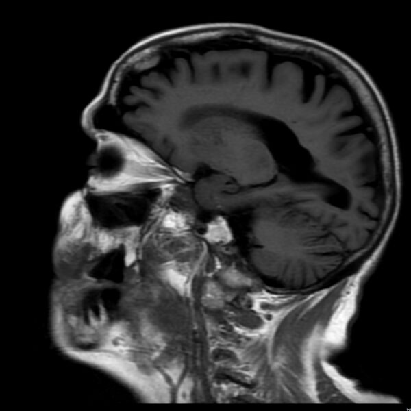 File:Cerebellar ataxia with neuropathy and vestibular areflexia syndrome (CANVAS) (Radiopaedia 74283-85159 Sagittal FLAIR 14).jpg