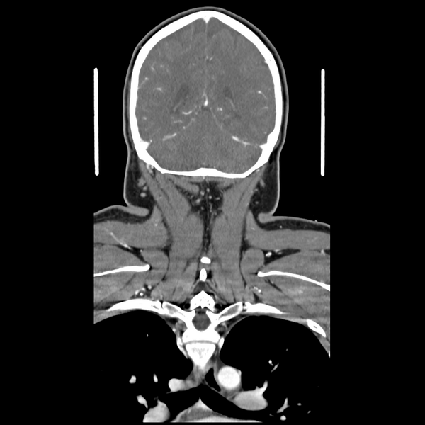 File:Cerebellar infarct due to vertebral artery dissection with posterior fossa decompression (Radiopaedia 82779-97029 D 47).png