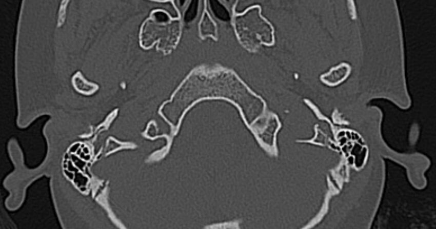 Cerebellopontine angle lipoma (Radiopaedia 57303-64242 Axial bone window 3).jpg