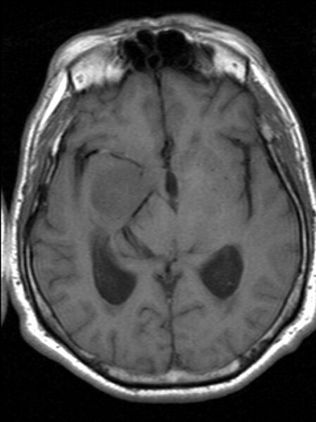 File:Cerebellopontine angle meningioma (Radiopaedia 24459-24764 Axial T1 11).jpg