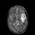Cerebral abscess post cardiac surgery (Radiopaedia 27244-27420 Axial T2 12).jpg