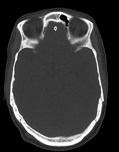 File:Cerebral abscesses (Radiopaedia 70458-80568 Axial bone window 25).jpg