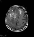 Cerebral abscesses secondary to contusions (Radiopaedia 5201-6968 Axial T1 1).jpg