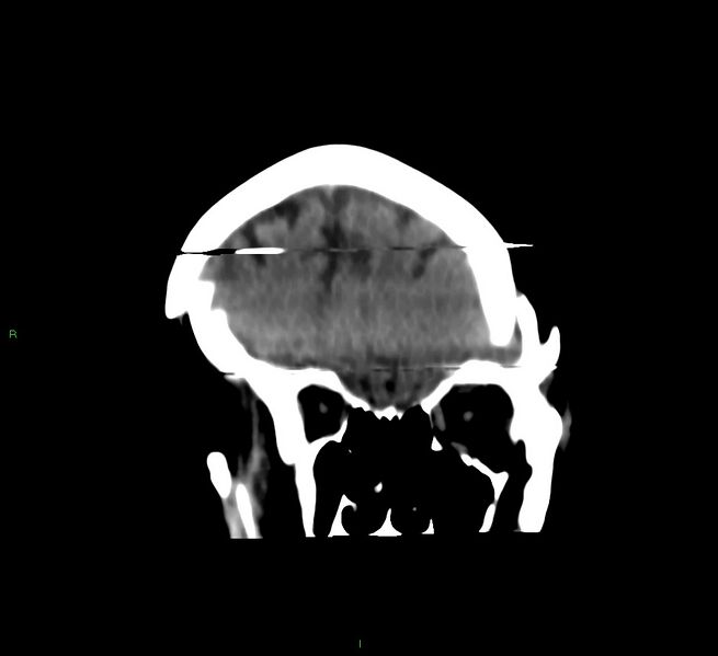 File:Cerebral amyloid angiopathy-associated lobar intracerebral hemorrhage (Radiopaedia 58377-65514 Coronal non-contrast 51).jpg