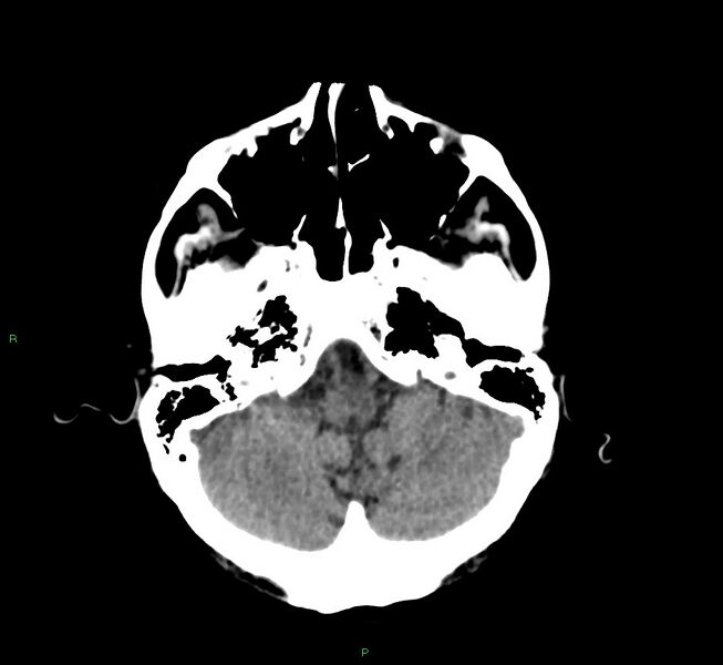 File:Cerebral amyloid angiopathy-associated lobar intracerebral hemorrhage (Radiopaedia 58530-65688 Axial non-contrast 41).jpg