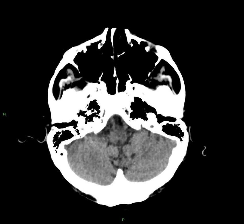 Cerebral amyloid angiopathy-associated lobar intracerebral hemorrhage (Radiopaedia 58530-65688 Axial non-contrast 41).jpg