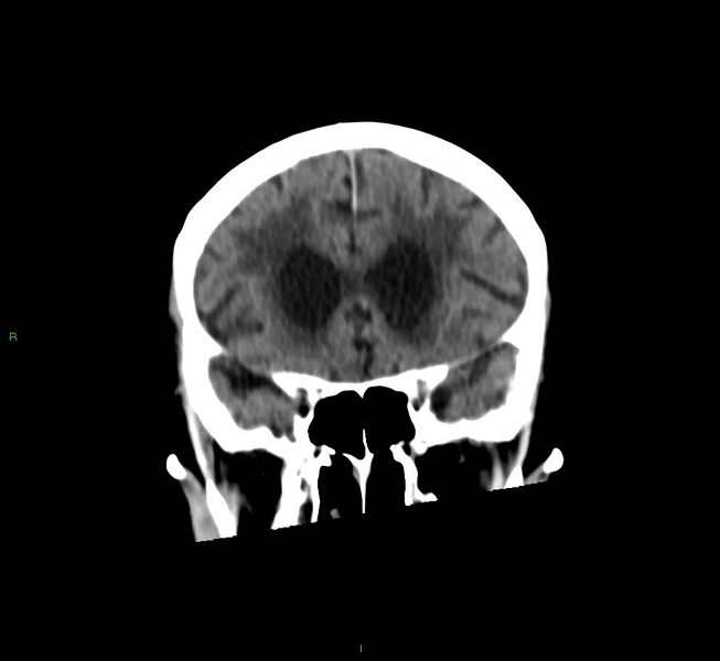 File:Cerebral amyloid angiopathy-associated lobar intracerebral hemorrhage (Radiopaedia 58530-65688 Coronal non-contrast 47).jpg