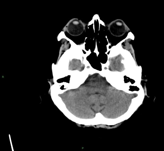 File:Cerebral amyloid angiopathy-associated lobar intracerebral hemorrhage (Radiopaedia 58561-65724 Axial non-contrast 37).jpg
