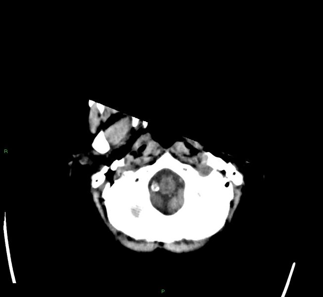 File:Cerebral amyloid angiopathy-associated lobar intracerebral hemorrhage (Radiopaedia 58563-65727 Axial non-contrast 48).jpg