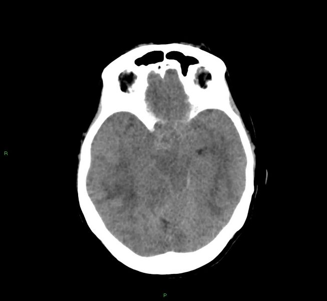 File:Cerebral amyloid angiopathy-associated lobar intracerebral hemorrhage (Radiopaedia 58751-65972 Axial non-contrast 32).jpg