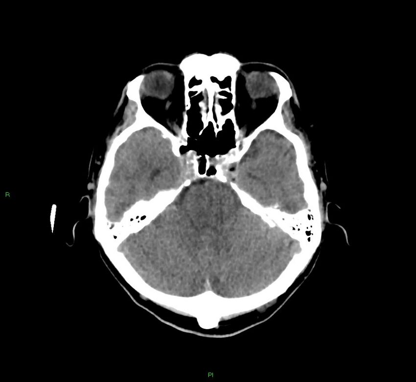 Cerebral amyloid angiopathy-associated lobar intracerebral hemorrhage (Radiopaedia 58756-65977 Axial non-contrast 37).jpg