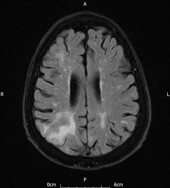 File:Cerebral amyloid angiopathy related inflammation (Radiopaedia 72772-83415 Axial FLAIR 16).jpg
