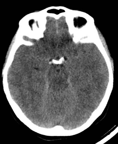 File:Cerebral edema due to severe hyponatremia (Radiopaedia 89826-106937 Axial non-contrast 34).jpg