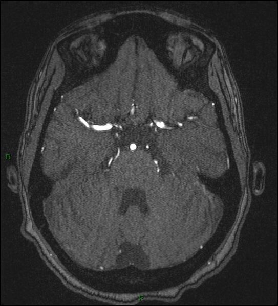 File:Cerebral fat embolism (Radiopaedia 35022-36525 Axial TOF 63).jpg