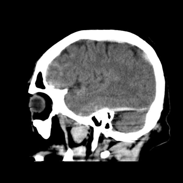 File:Cerebral hemorrhagic contusions (Radiopaedia 23145-23188 C 11).jpg