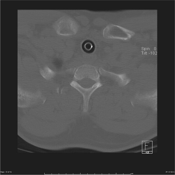 File:Cerebral hemorrhagic contusions and cervical spine fractures (Radiopaedia 32865-33841 C 33).jpg