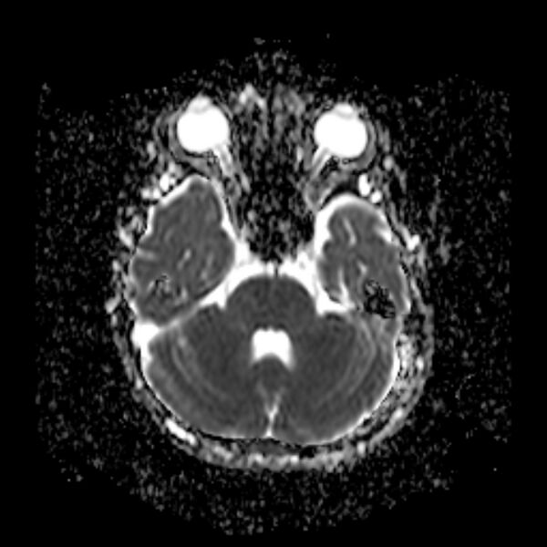 File:Cerebral tuberculoma (Radiopaedia 41152-43932 Axial ADC 6).jpg