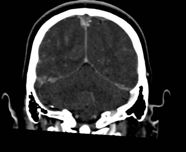 File:Cerebral venous sinus thrombosis (Radiopaedia 59224-66646 Coronal C+ delayed 57).jpg