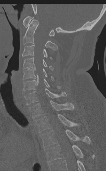 File:Cervical canal stenosis due to ossification of the posterior longitudinal ligament (Radiopaedia 47260-51823 Sagittal bone window 36).png