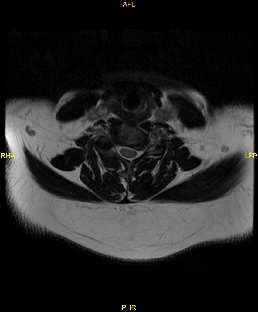 Cervical disc protrusion (Radiopaedia 87147-103415 Axial T2 34).jpg