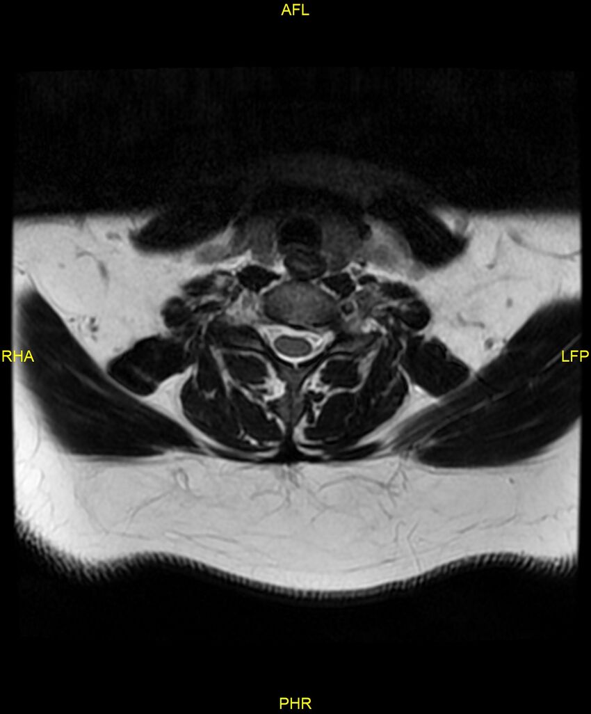 Cervical disc protrusion (Radiopaedia 87147-103415 Axial T2 46).jpg