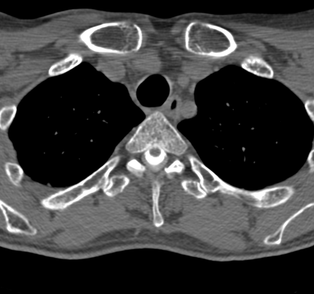 File:Cervical dural CSF leak on MRI and CT treated by blood patch (Radiopaedia 49748-54996 B 46).png