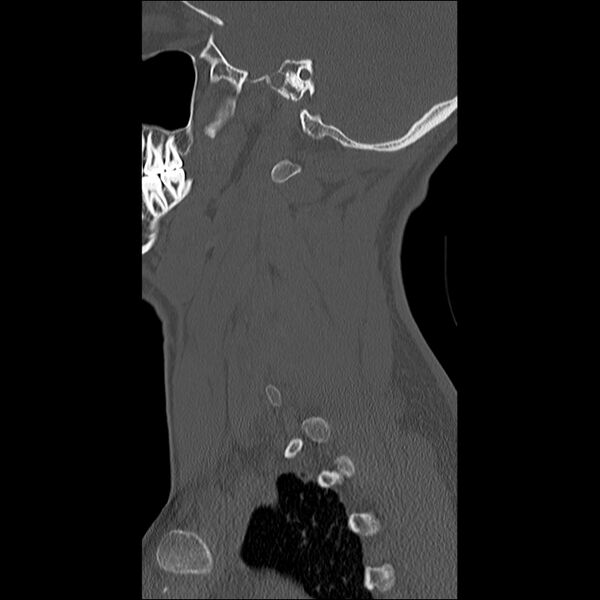File:Cervical facet fracture and anterior discoligamentous injury (Radiopaedia 32139-33083 Sagittal bone window 35).jpg