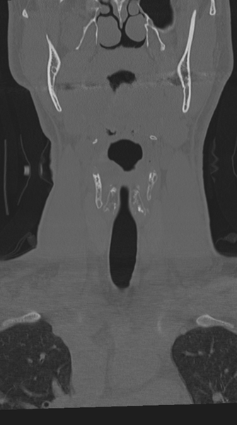 File:Cervical intercalary bone (Radiopaedia 35211-36748 Coronal bone window 14).png