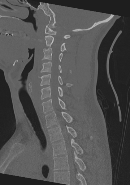 File:Cervical intercalary bone (Radiopaedia 35211-36748 Sagittal bone window 35).png