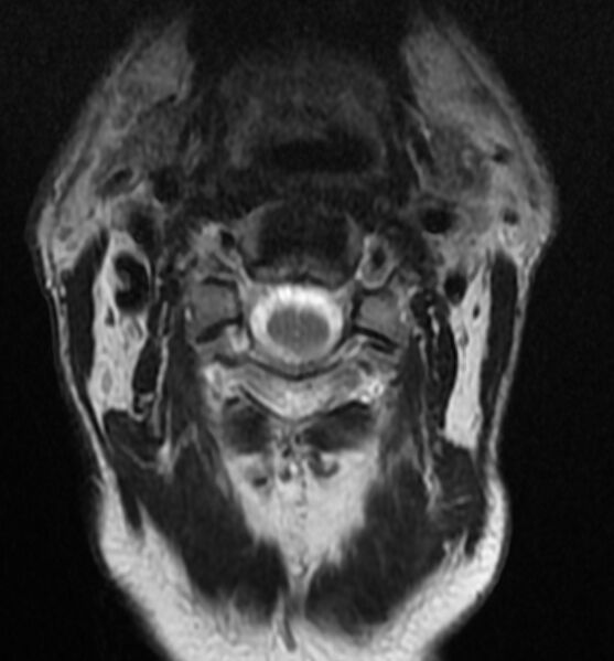 File:Cervical spondylodiscitis (Radiopaedia 81362-95110 Axial T2 1).jpg