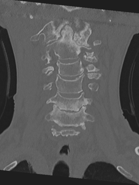 File:Cervical spondylolysis (Radiopaedia 49616-54811 Coronal bone window 16).png