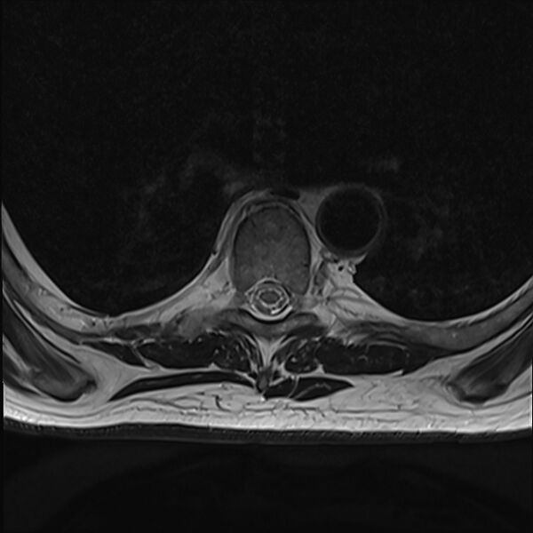 File:Cervical tumor-like myelopathy due to Type V dAVF (Radiopaedia 82461-96604 D 25).jpg
