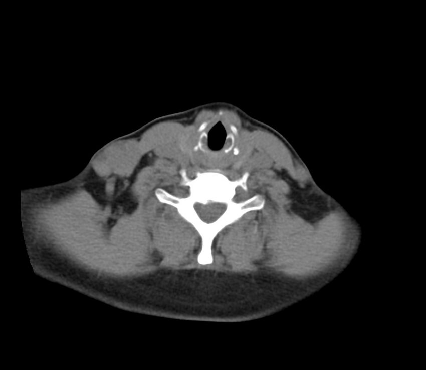 Cervical venous malformation (Radiopaedia 22653-22672 Axial non-contrast 40).jpg