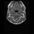 Cervical vertebrae metastasis (Radiopaedia 78814-91667 Axial T1 6).png