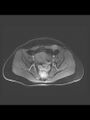 Cesarean section scar endometrioma (Radiopaedia 56569-63297 Axial T1 C+ fat sat 23).jpg
