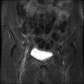 Cesarian section scar endometriosis (Radiopaedia 66520-75799 Coronal STIR 9).jpg